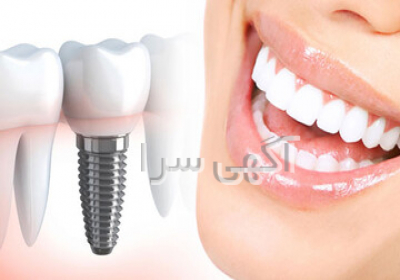 ایمپلنت ۱۵۶۰۰ در تهران عنوان ایمپلنت اقساطی با قیمت ویژه | ویزیت و روکش